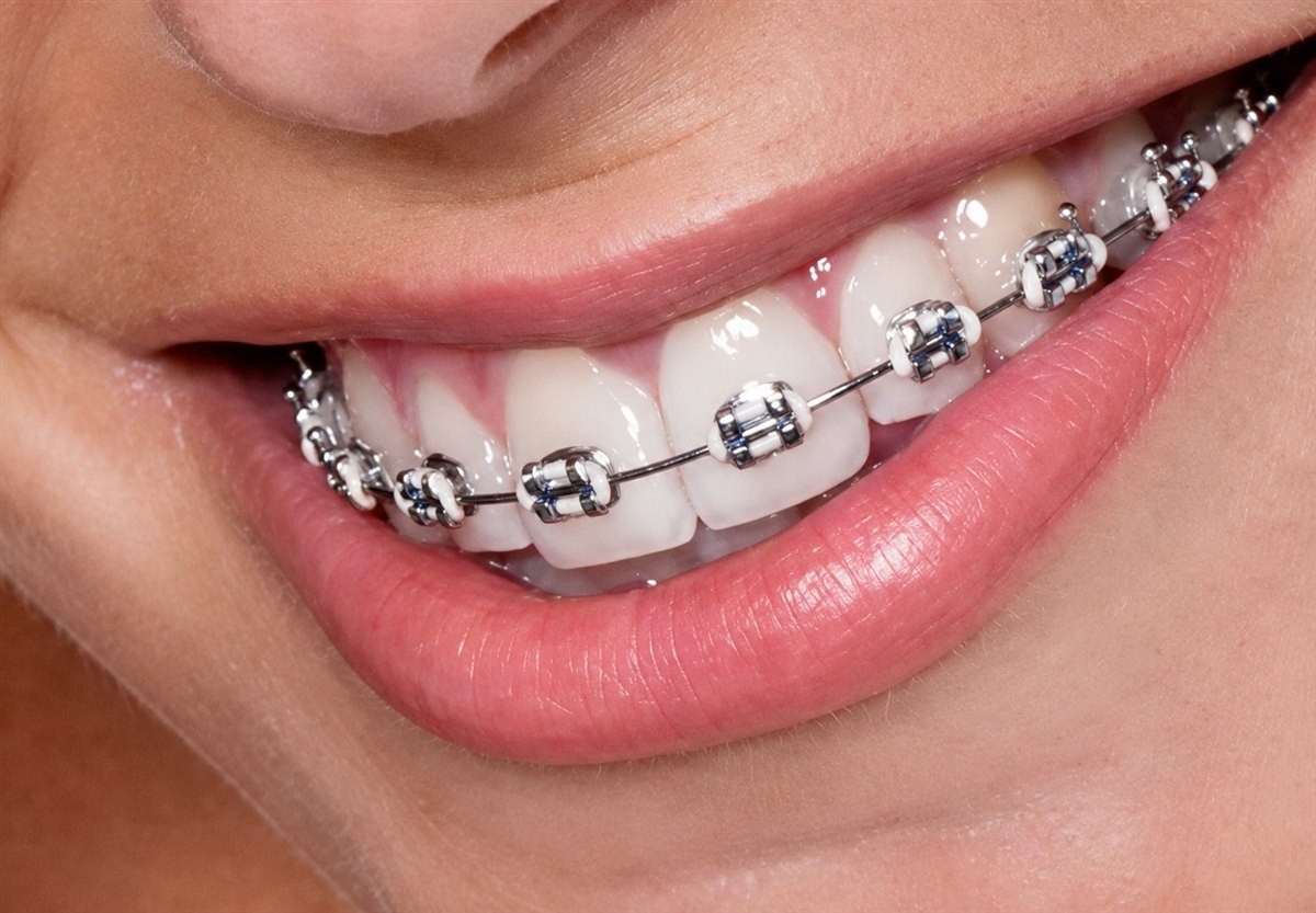 Sorriso com aparelho ortodôntico autoligado