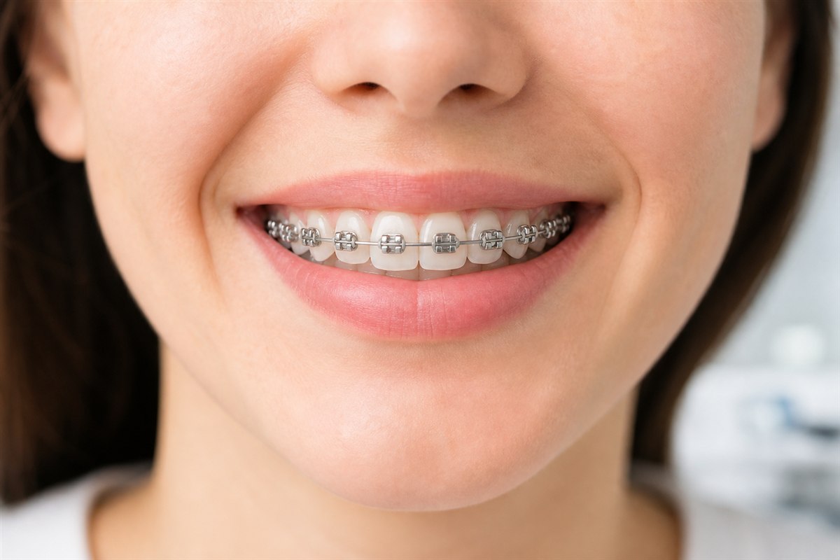 Sorriso ilustrativo com aparelho convencional metálico