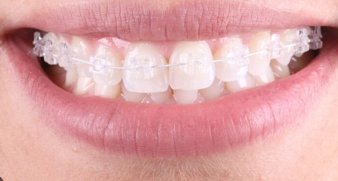 Sorriso com aparelho ortodôntico estético transparente