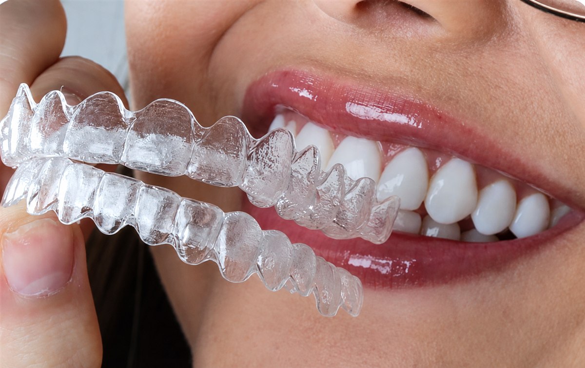 Alinhadores transparentes do tratamento Invisalign