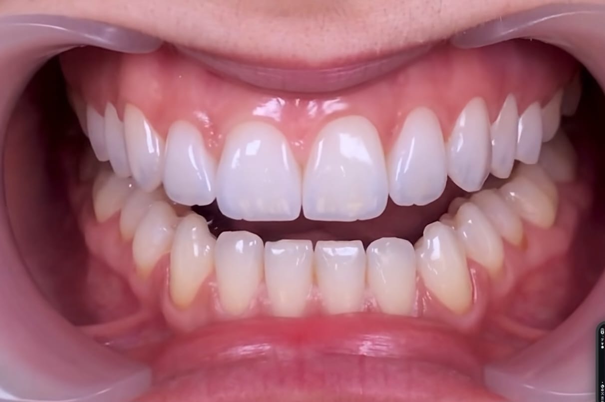 Sorriso com resultado ilustrativo de facetas dentárias em Florianópolis
