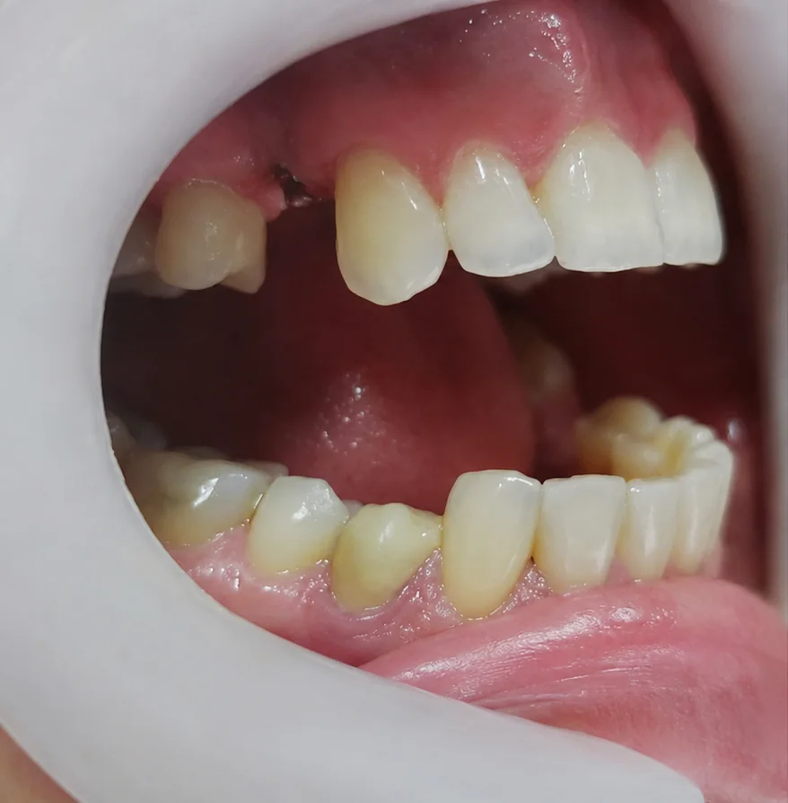Antes do implante unitário com ausência de um dente