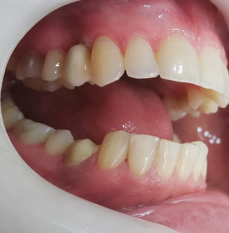 Depois da reabilitação com implante dentário unitário